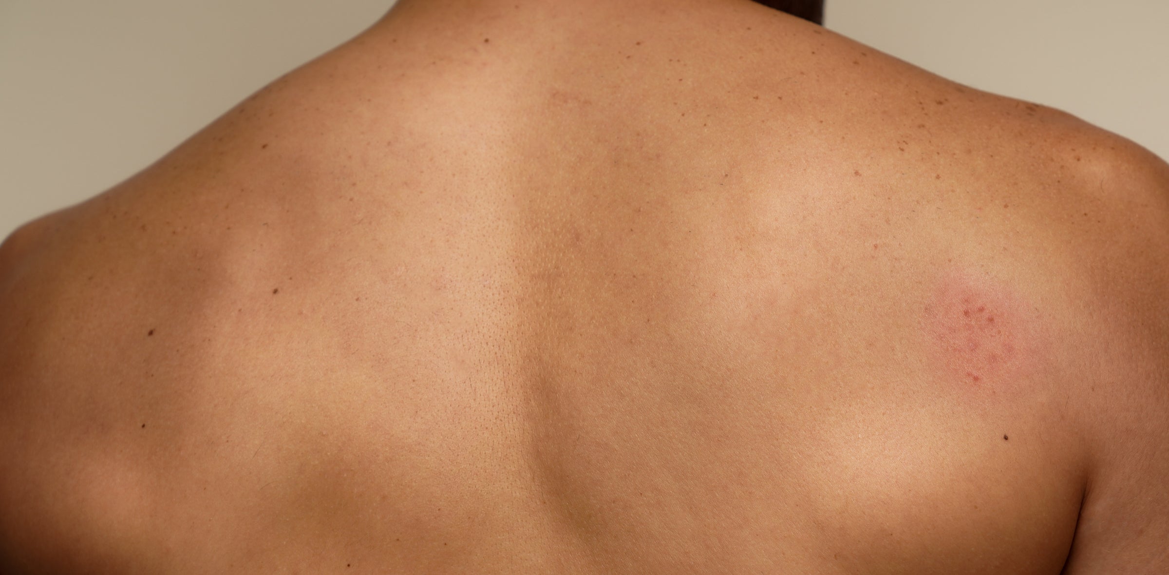 Image of a person's back with irritated skin patch