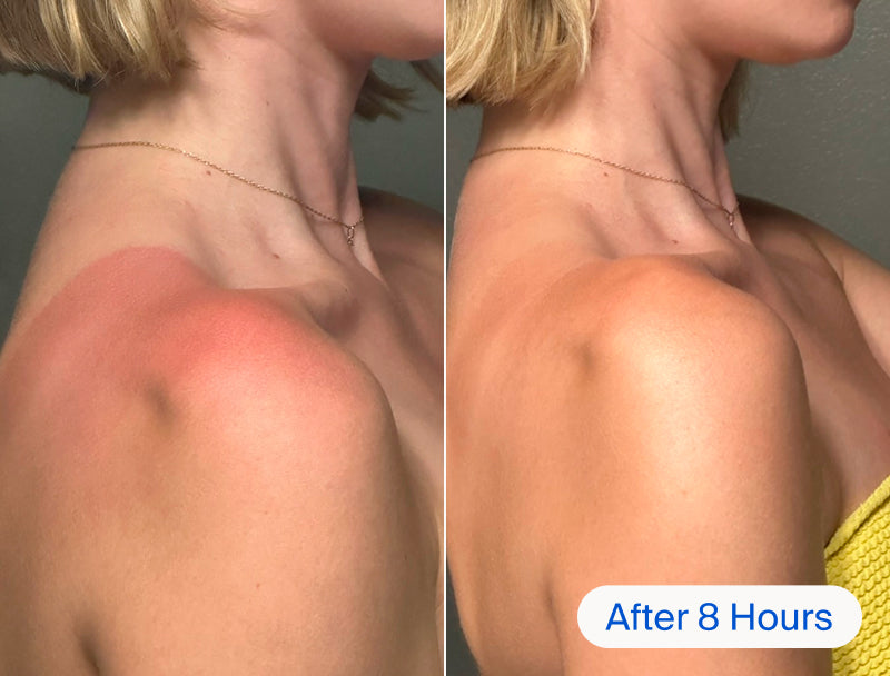 Before and after of a sunburn on a woman's shoulder.