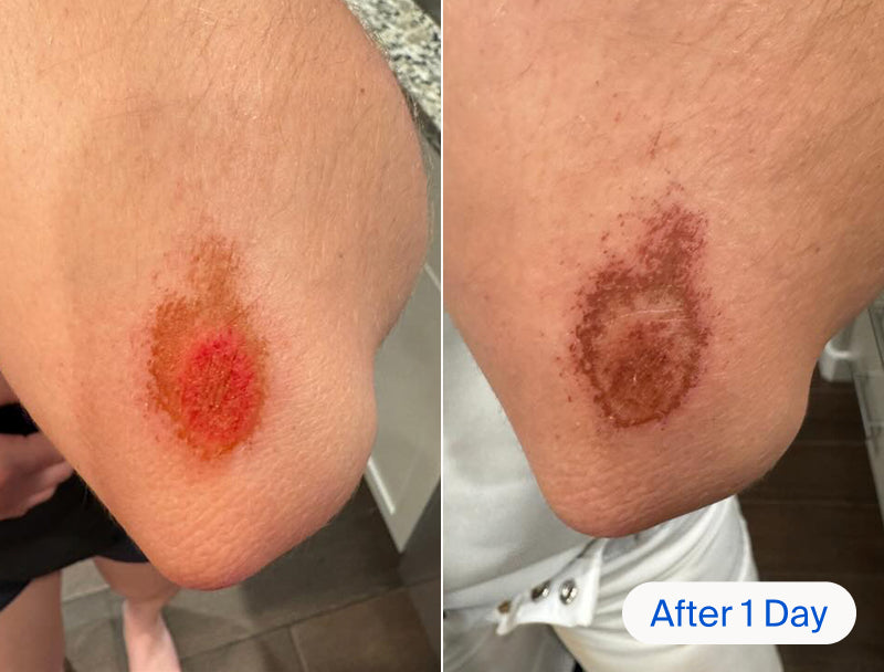 Before and after of a scrape on a person's elbow.