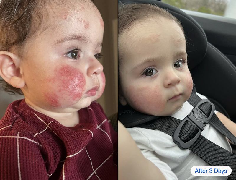 Before and after of a baby's skin flare-up