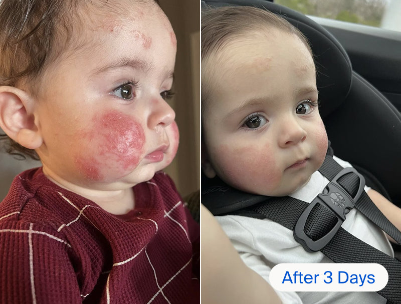 Before and after of a baby's skin flare-up.