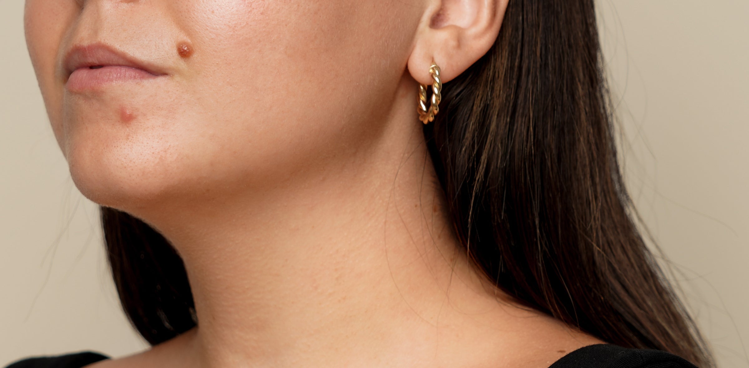 Image of a persons face with a pimple on their chin 