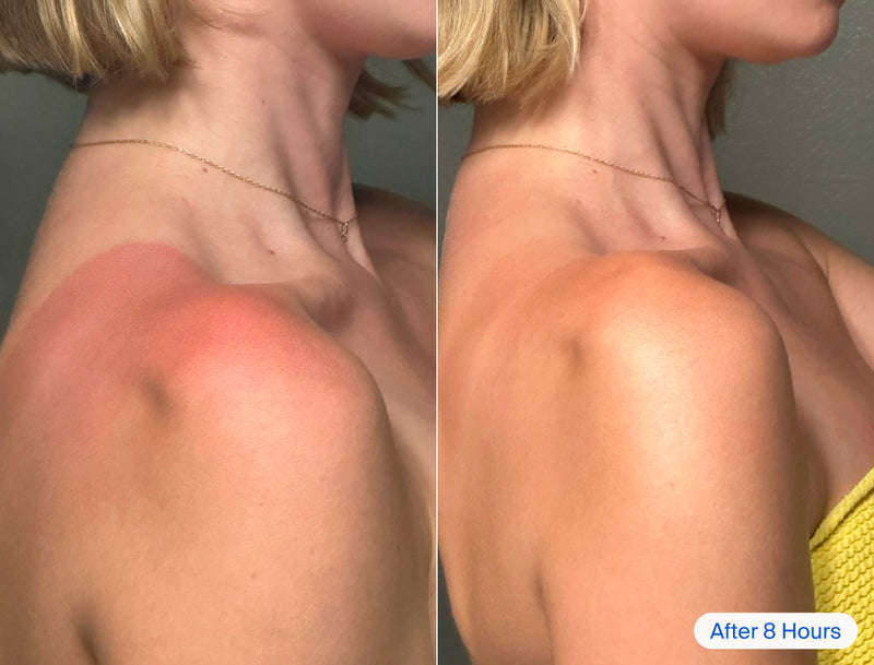 Before and after of a sunburn on a woman's shoulder.